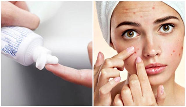 Thuốc trị mụn bọc