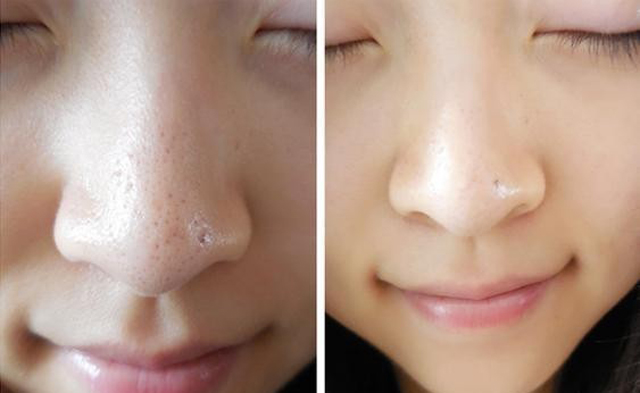 Thuốc trị mụn cám