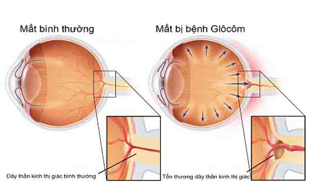 Tăng nhãn áp glocom - Thông tin về bệnh tăng nhãn áp glocom, là gì, dấu hiệu nhận biết