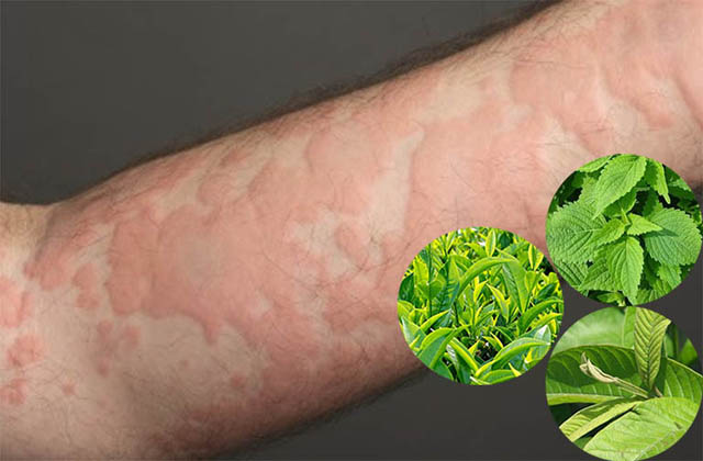 Trẻ bị nổi mề đay tắm lá gì