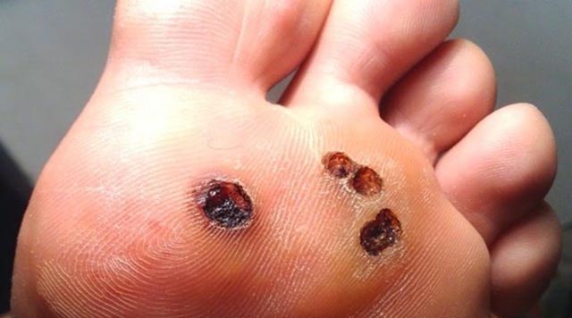 Trị mụn cóc bằng nhang