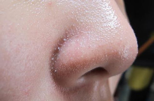 Trị mụn trứng cá ở mũi