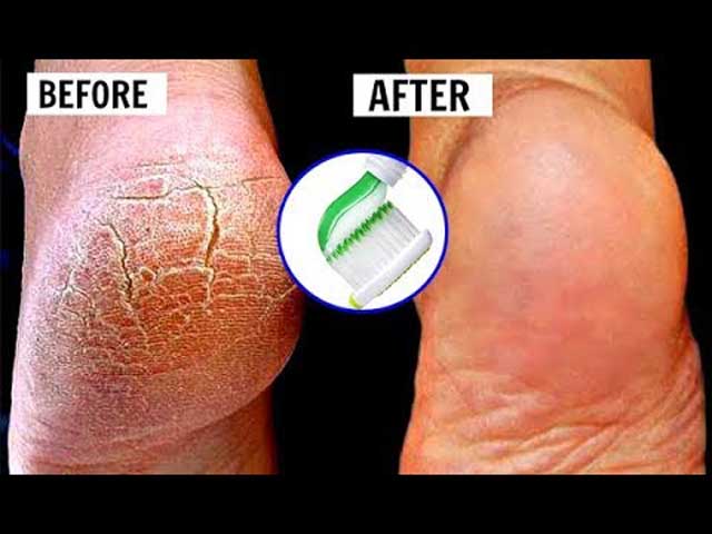 Trị nứt gót chân bằng kem đánh răng