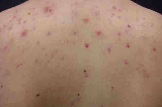 Triệu chứng bệnh gan nóng
