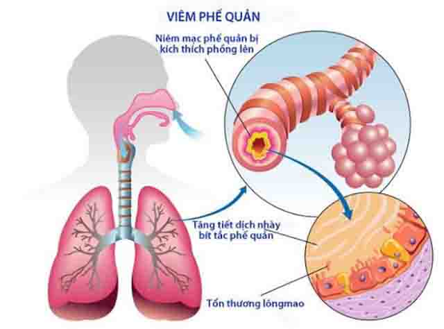 Triệu chứng lâm sàng của viêm phổi