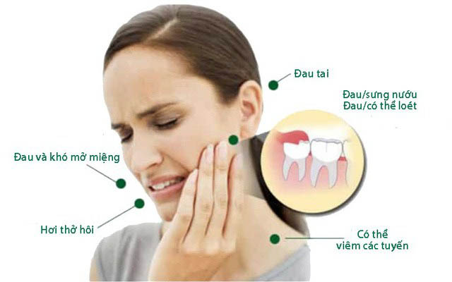 Triệu chứng mọc răng khôn