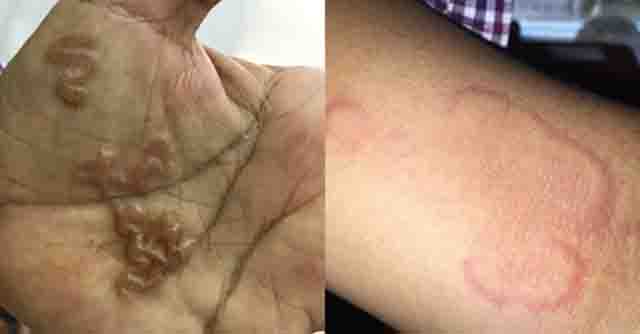 Triệu chứng nhiễm giun sán chó