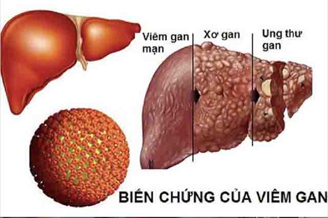Triệu chứng viêm gan b nặng