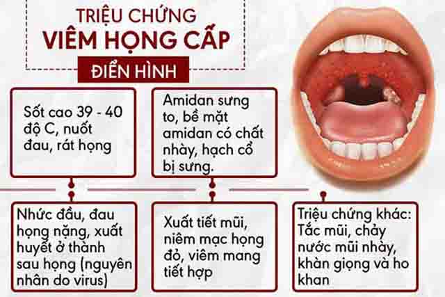 Triệu chứng viêm họng cấp