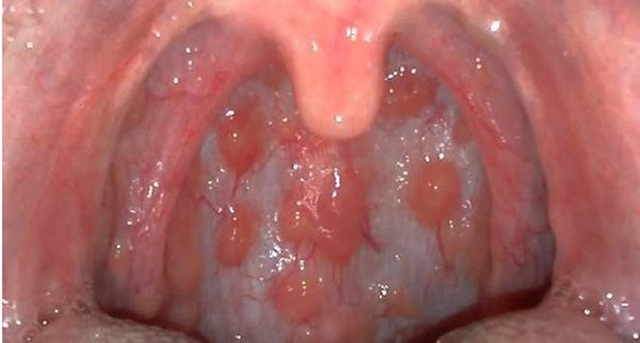 Triệu chứng viêm họng hạt
