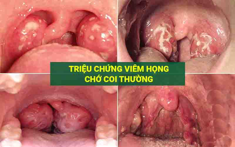 Triệu chứng viêm họng