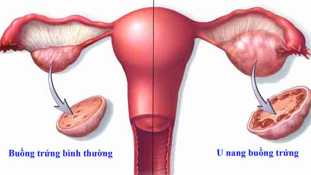 Bệnh u nang buồng trứng có nguy hiểm không