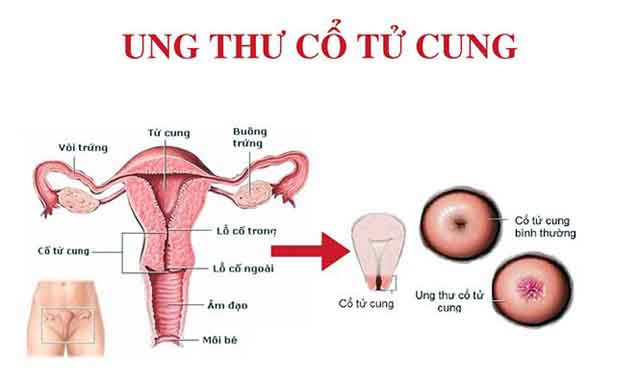 Nguyên nhân ung thư cổ tử cung
