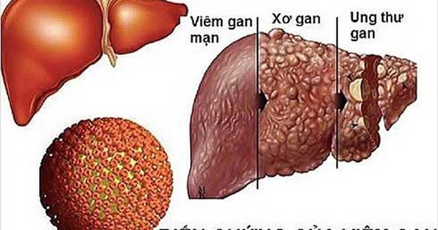 Ung thư gan có chữa được không