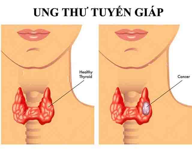 Ung thư tuyến giáp - Tìm hiểu bệnh ung thư tuyến giáp, nguyên nhân, dấu hiệu ​