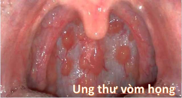 Nguyên nhân ung thư vòm họng