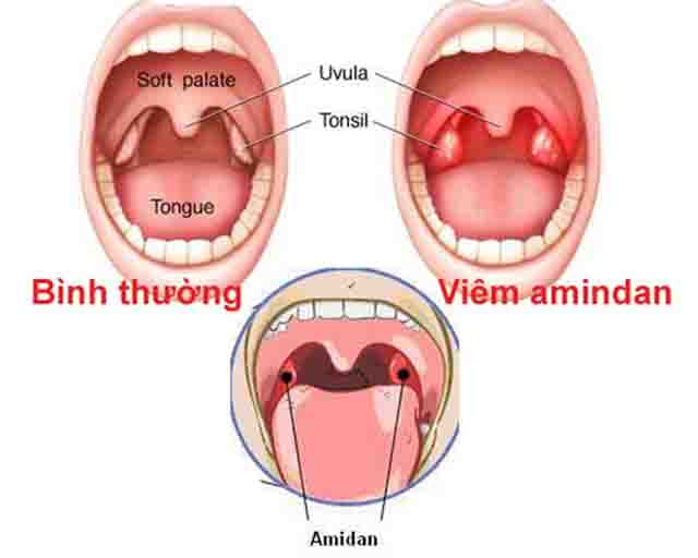 Bệnh viêm họng và cách điều trị hiệu quả