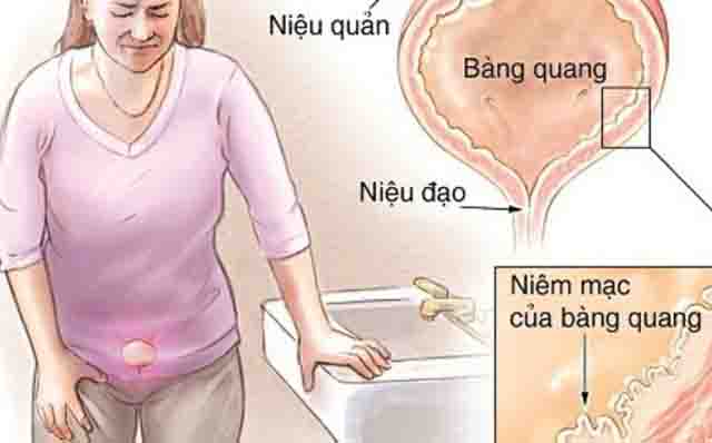 Bệnh viêm bàng quang và cách điều trị hiệu quả