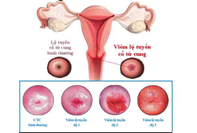 Các phương pháp điều trị viêm cổ tử cung