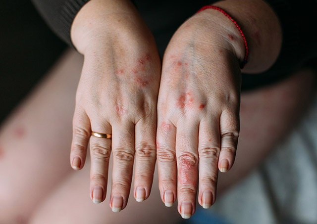 Viêm da cơ địa và cách điều trị hiệu quả