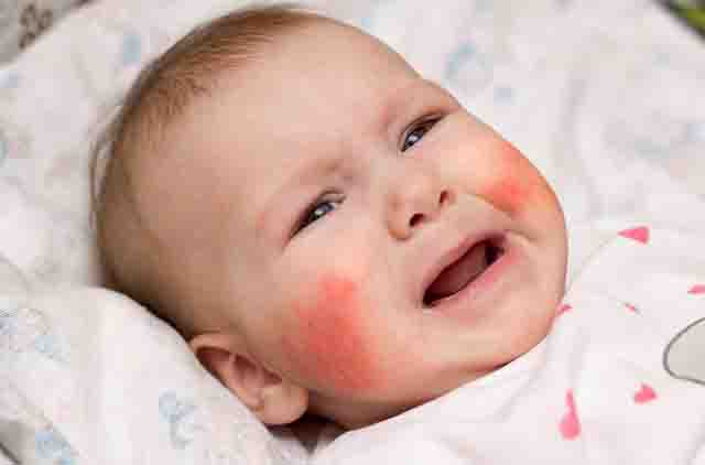 Viêm da dị ứng ở trẻ sơ sinh - Nguyên nhân và triệu chứng bệnh viêm da dị ứng ở trẻ sơ sinh