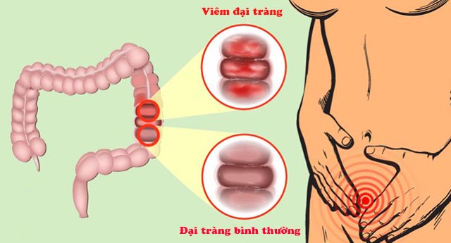 Viêm đại tràng và cách điều trị hiệu quả