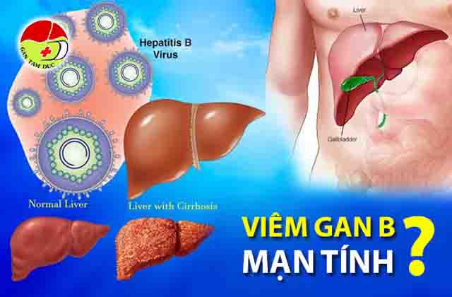 Viêm gan B mãn tính