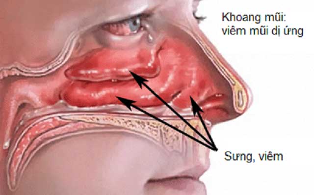 Bệnh viêm mũi dị ứng có nguy hiểm không