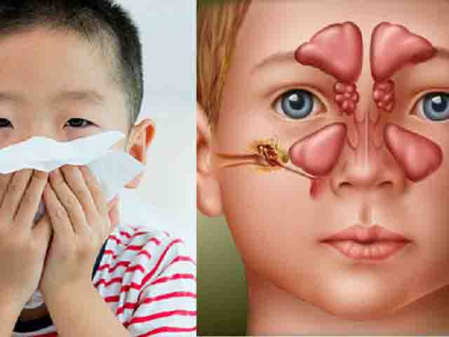 Viêm mũi xoang cấp - Tìm hiểu bệnh do vi khuẩn viêm mũi xoang cấp