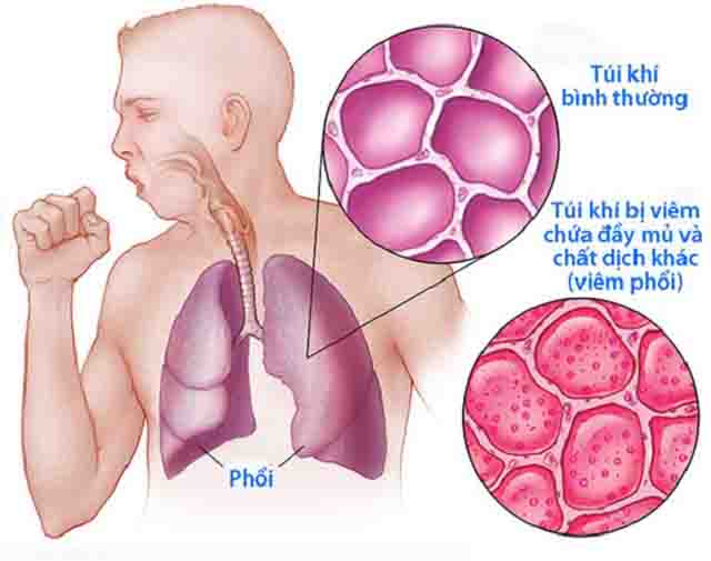 Hen phế quản và cách điều trị hiệu quả