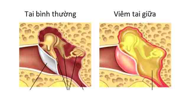 Viêm tai giữa - Ngăn chặn nguy cơ chậm nói từ viêm tai giữa