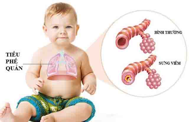 Viêm tiểu phế quản ở trẻ em – Nguyên nhân khiến trẻ bị viêm tiểu phế quản, triệu chứng