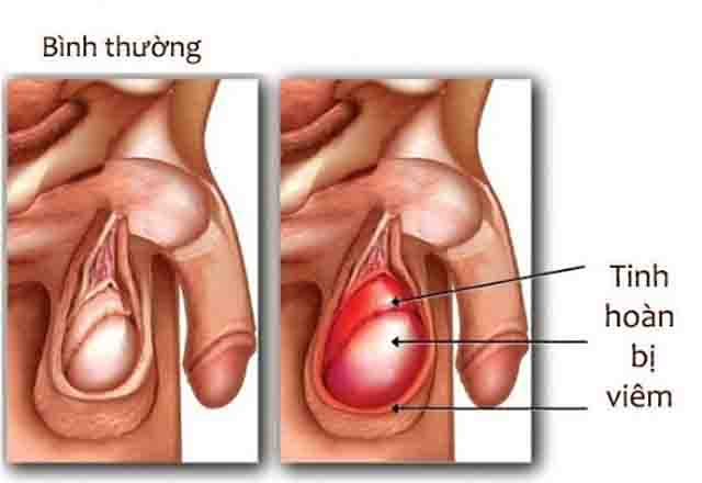 Viêm tinh hoàn -Tìm hiểu về bệnh viêm tinh hoàn, nguyên nhân, triệu chứng