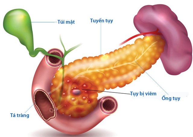 Viêm tụy - Nguyên nhân biến chứng của bệnh viêm tụy