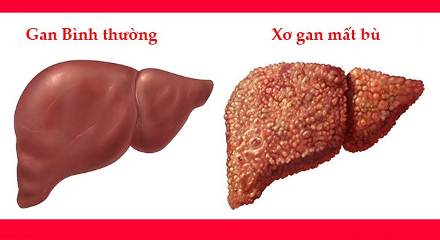 Bệnh xơ gan có chữa được không
