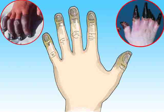 Bỏng lạnh - Những cách xử trí khi bị bỏng lạnh