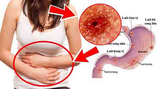 Xuất huyết dạ dày - Một số triệu chứng xuất huyết dạ dày, biện pháp phòng ngừa