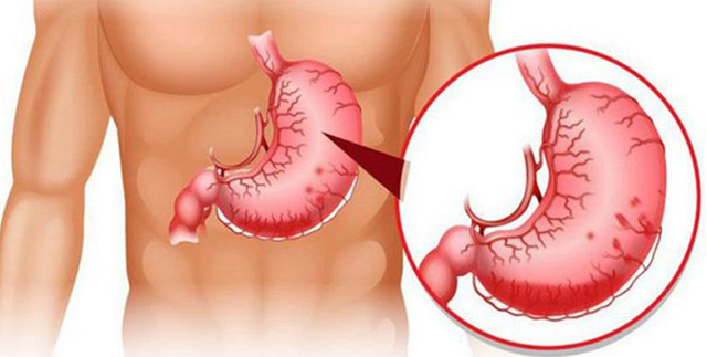 Bị xuất huyết dạ dày nên ăn gì